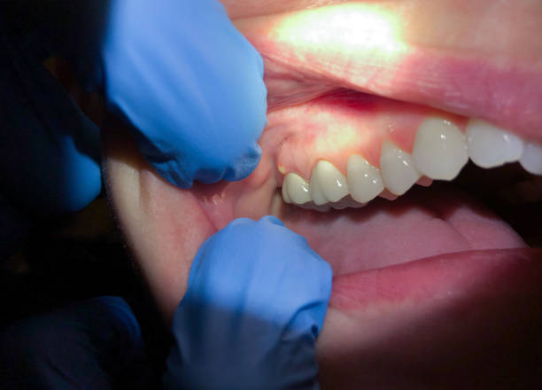 Best Emergency Treatment for Dental Infections or Abscesses in Pelican Bay, FL